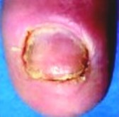 paronychia