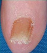 Fungal nail infection